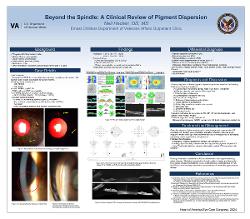 Beyond the Spindle: A Clinical Review of Pigment Dispersion